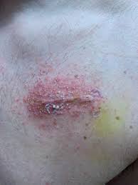 How long should you stay in a steam room and how often should anyone go in a steam room? Reaction From Steri Strips Adhesive And Razor Burn After Defibrillator Replacement 10 Days Post Op Medizzy