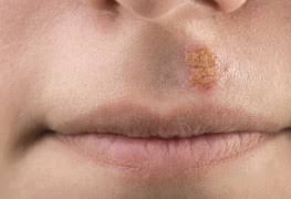 Qu'il disparaisse le plus rapidement possible. Y A T Il Un Remede Permanent Contre L Herpes Buccal Trucs Pratiques