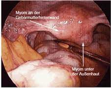 Durch eine vielzahl möglicher symptome bemerkbar machen. Gebarmuttererhaltende Myombehandlungen Wie Myomembolisation Und Mrgfus Methode