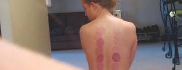 What is cupping used for? What Does Cupping Really Feel Like