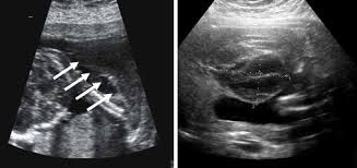 The gestational sac may also be discernible. Subchorionic Hematoma San Diego Perinatal Center