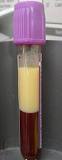 Image result for icd code for hypertriglyceridemia