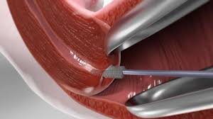 Image result for Pap Smear