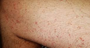 These tiny red dots on skin have characteristic red color due to the broken blood vessels inside. 8 Ways The Coronavirus Can Affect Your Skin From Covid Toes To Rashes And Hair Loss