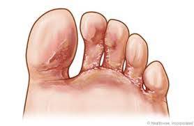 Athlete S Foot What Is It And Why Should You Care Audrey Wall Nursing Professional Corporation