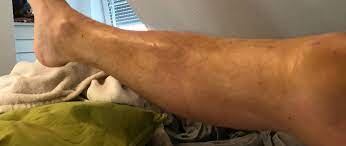Finde Heraus Ob Dein Bluterguss Nach Knie Op Harmlos Ist Oder Nicht Knie Marathon Knie Op Reha Patienten Aufgepasst