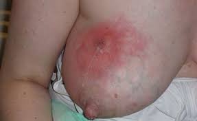 Milchstau Mastitis Und Abszess