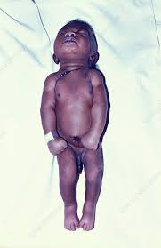 Image result for Tetanus