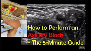 Image result for Axillary Nerve Block