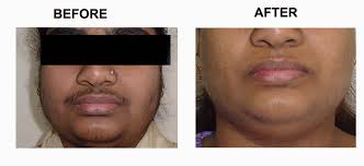 However, it isn't for everyone. Upper Lip Hair Removal Photo Amrit Clinic