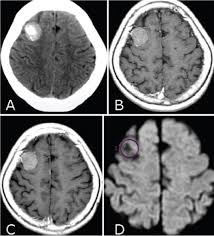 What is ct scanning of the head? Apparent Diffusion Coefficients For Evaluation Of The Response Of Brain Tumors Treated By Gamma Knife Surgery In Journal Of Neurosurgery Volume 113 Issue Special Supplement 2010