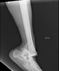 Image result for Ankle Dislocation