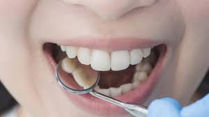 Namun pada pasien dengan gigi kuning yang cukup parah, dibutuhkan terapi lanjutan untuk menghilangkan gigi kuning. Cara Memutihkan Gigi Kuning Sikat Gigi Yang Benar Gunakan Soda Kue Dan Hidrogen Peroksida Tribunnews Com Mobile