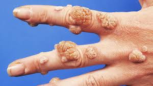 Image result for Skin Infection