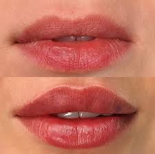 Fotona LipLase - Non-Invasive Plumping for Fuller Lips