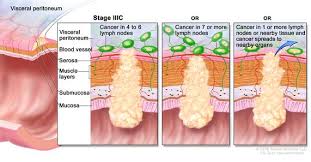 Definition Of Stage Iiic Colorectal Cancer Nci Dictionary Of Cancer Terms National Cancer Institute