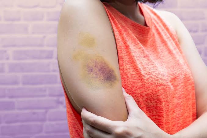 Bruising Easily: Causes, Risks, Treatment
