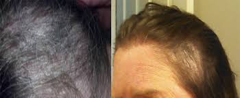 He attended several commercial photography courses which inspired him to enroll in cosmetology school briefly after moving to los angeles. Wen Hair Care Lawsuit See Photos Of Hair Loss People Com