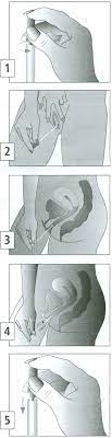 It is carried out under aseptic conditions, by a healthcare professional. Instructions For Self Collection Of Vaginal Swabs Hull University Teaching Hospitals Nhs Trust