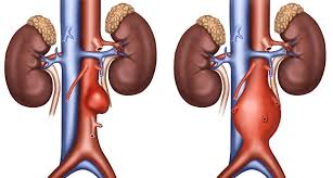 O que é aneurisma1 cerebral? Aneurismas Da Aorta Abdominal E Perifericos Dra Ana Paula Pires
