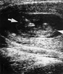 assessment of gestational age by ultrasound glowm