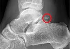 Os Trigonum Syndrome Causes Symptoms Treatment