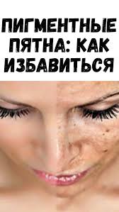как быстро избавиться от пятен после прыщей на лице Sovety I Recepty V 2020 G Osvetlit Lico Otbelivanie Kozhi Podtyazhka Kozhi