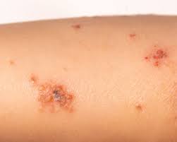 Impetigo: All You Need To Know | Cdc