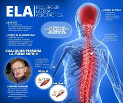 La esclerosis lateral amiotrófica (ela) es la enfermedad de la neurona motora (enm) más común. Ela Esclerosis Lateral Amiotrofica Que Es Causas Sintomas Tratamiento Y Consejos Fisioonline