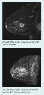 A breast mri usually is performed after you have a biopsy that's. Breast Mri Fact Sheet Westmead Bci