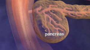 Mutations that happen during a person's lifetime, rather than inherited mutations, cause most. Why Pancreatic Cancer Is So Deadly Ctv News