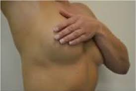 Image result for Intertrigo under breasts