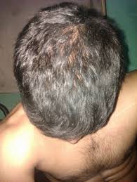Autologous growth factors hair loss therapy has been tested in cases of diffuse alopecia and is currently used with excellent results, in combination with supportive treatment or medication. 24 With Diffuse Hair Loss 6 Yrs Currently On Finpecia On Minoxidil 5 4 Months Hairlosstalk Forums