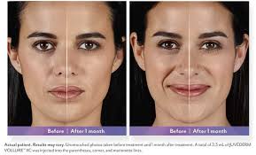 A number one source for competitive rates How Juvederm Vollure Volbella Fill Medium Deep Lines