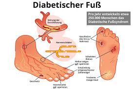 Patienten, die an einem charcot fuß leiden, sind in der chirurgischen oder orthopädischen praxis nicht allzu selten. Diabetischer Fuss