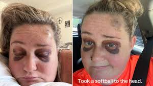 Bride hit by softball 5 days before wedding