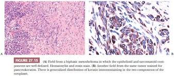 As a mesothelioma patient, it is important to be aware of your cell histology. Pleura Basicmedical Key