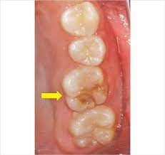 モリタ】幼若永久歯への既製冠の応用｜デンタルマガジン｜歯科情報ポータルサイト デンタルプラザ