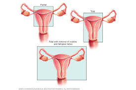 Cervical cancer treatment options include surgery, radiotherapy, chemotherapy, or combinations of regular cervical screening might help a person identify and deal with signs of cancer before the people who have had a hysterectomy with removal of the cervix do not need screening, unless they. Hysterectomy Health Navigator Nz