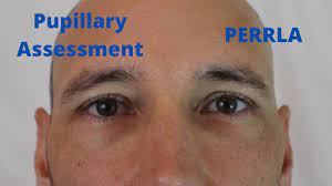Pupillary Assessment (Perrla) - Youtube