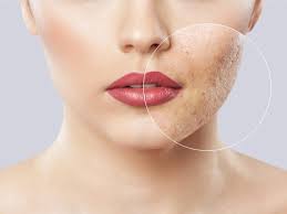 5 Different Types Of Skin Blemishes On The Face And Its Treatments Skinkraft
