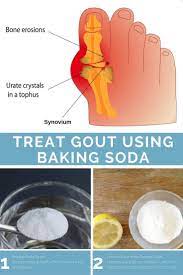 Pin On Gout