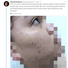 Seperti yang banyak diketahui selama ini, bengkuang dipercaya dapat 9. Lelaki Ini Dedah Rahsia Hilangkan Parut Jerawat Merah Dan Buat Wajahnya Terus Glowing Hijabista