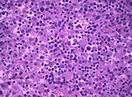 At the same time, the lymph node structure is erased, but a large number of pathological blood vessels form around it, provoking. Pathology Outlines T Cell Histiocyte Rich
