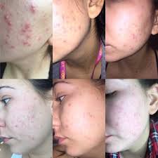How to use tretinoin for acne. Tretinoin For Acne Beautylish