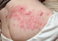 Shingles rash on the skin - Stock Image - C016/8264 - Science Photo Library