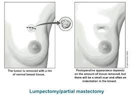 Breast Conserving Surgery Lumpectomy Bcs Breast Surgery