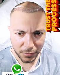 Dile adiós a la calvicie 👩🏼‍🦲👨🏻‍🦲y olvídate de las, gorras 🧢💥,  Agenda tu valoración con nuestros especialistas capilares., Ya no necesitas  volar hasta Turkia., Procedimiento permanente sin dolor, ...