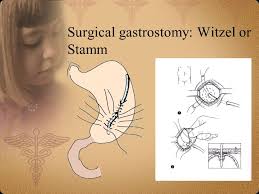 The witzel jejunostomy is the most common method of jejunostomy creation. Gastrostomy In Children Dr Osama Bawazir Assistant Professor Consultant Pediatric Surgeon Frcsi Frcs Ed Frcs Glas Frcsc Faap Facs Ppt Download
