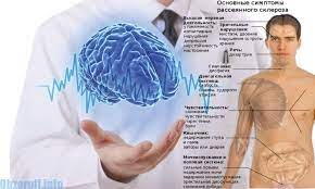 Persoanele care sufera de scleroza multipla spun ca simt prezenta unor ace in corp. Scleroza Multipla Sex Antrenare Sexuala Si Orgasm